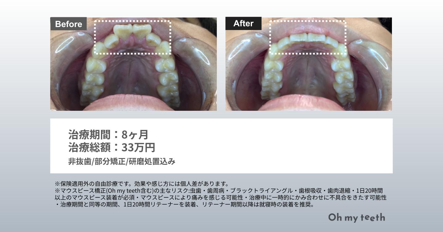 部分矯正 出っ歯 症例画像③