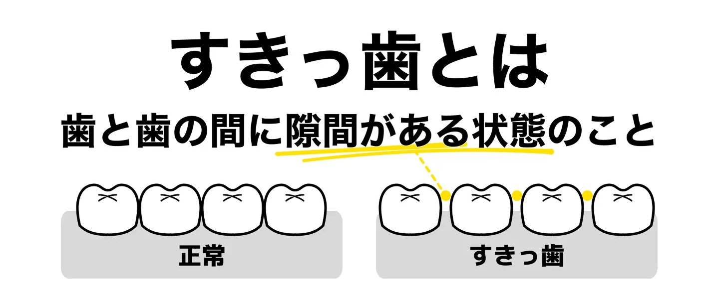 すきっ歯とは