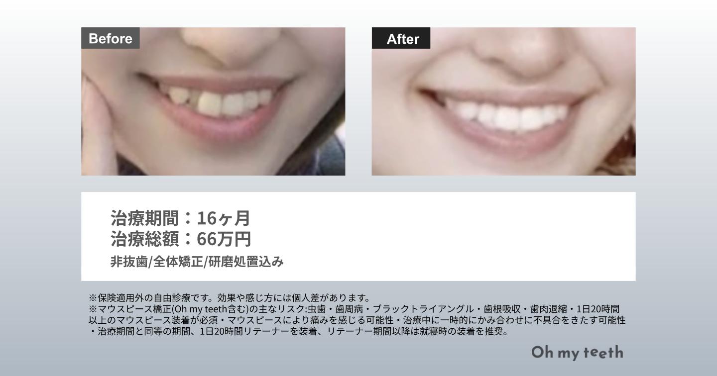 八重歯症例Pro