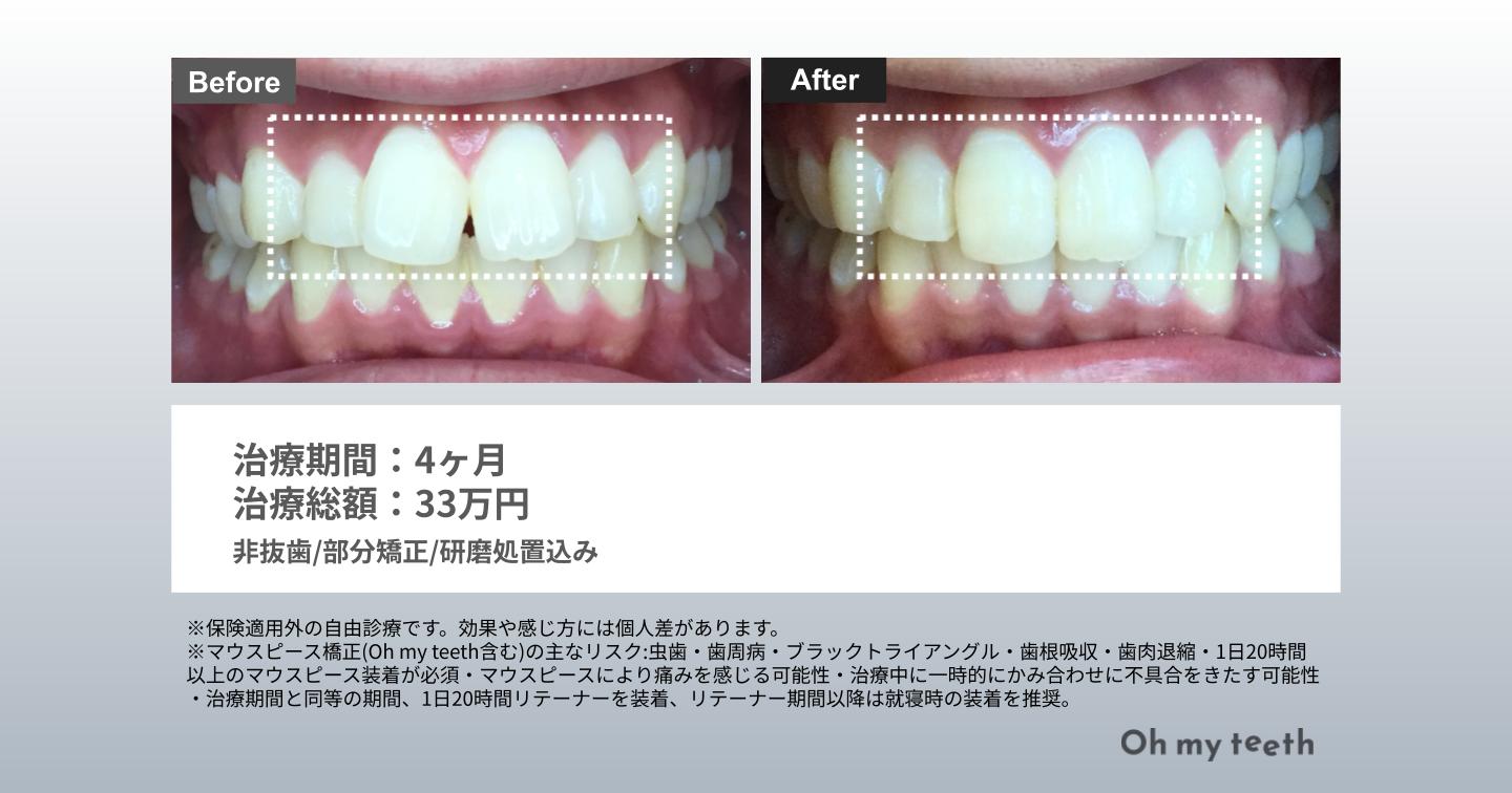 すきっ歯 矯正 前歯だけ 症例写真（スキッパ4ヶ月）