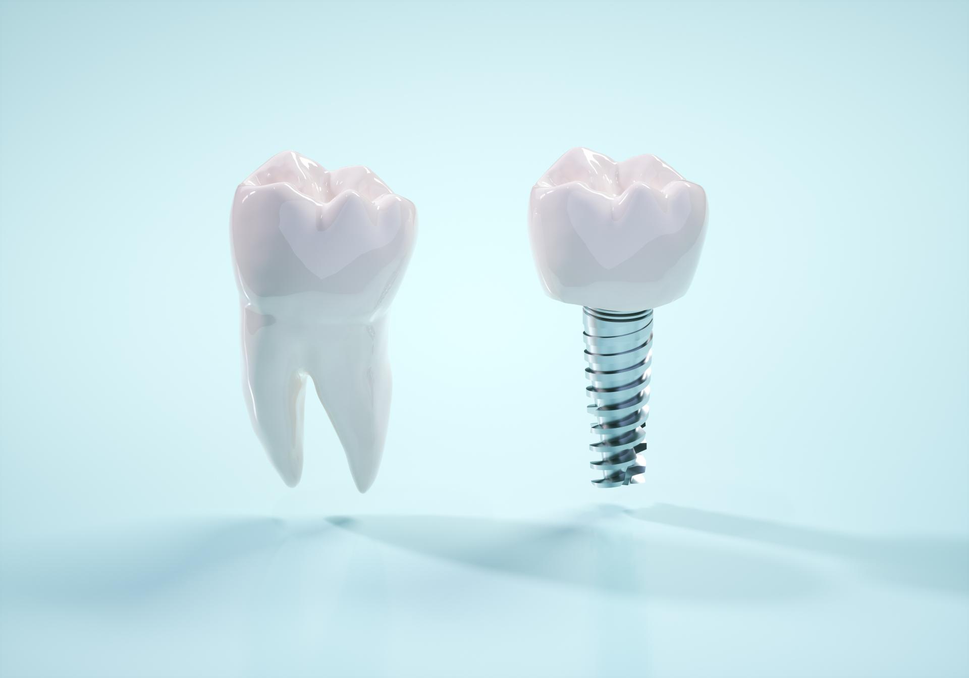 差し歯以外の補綴治療をしててもマウスピース矯正はできる?