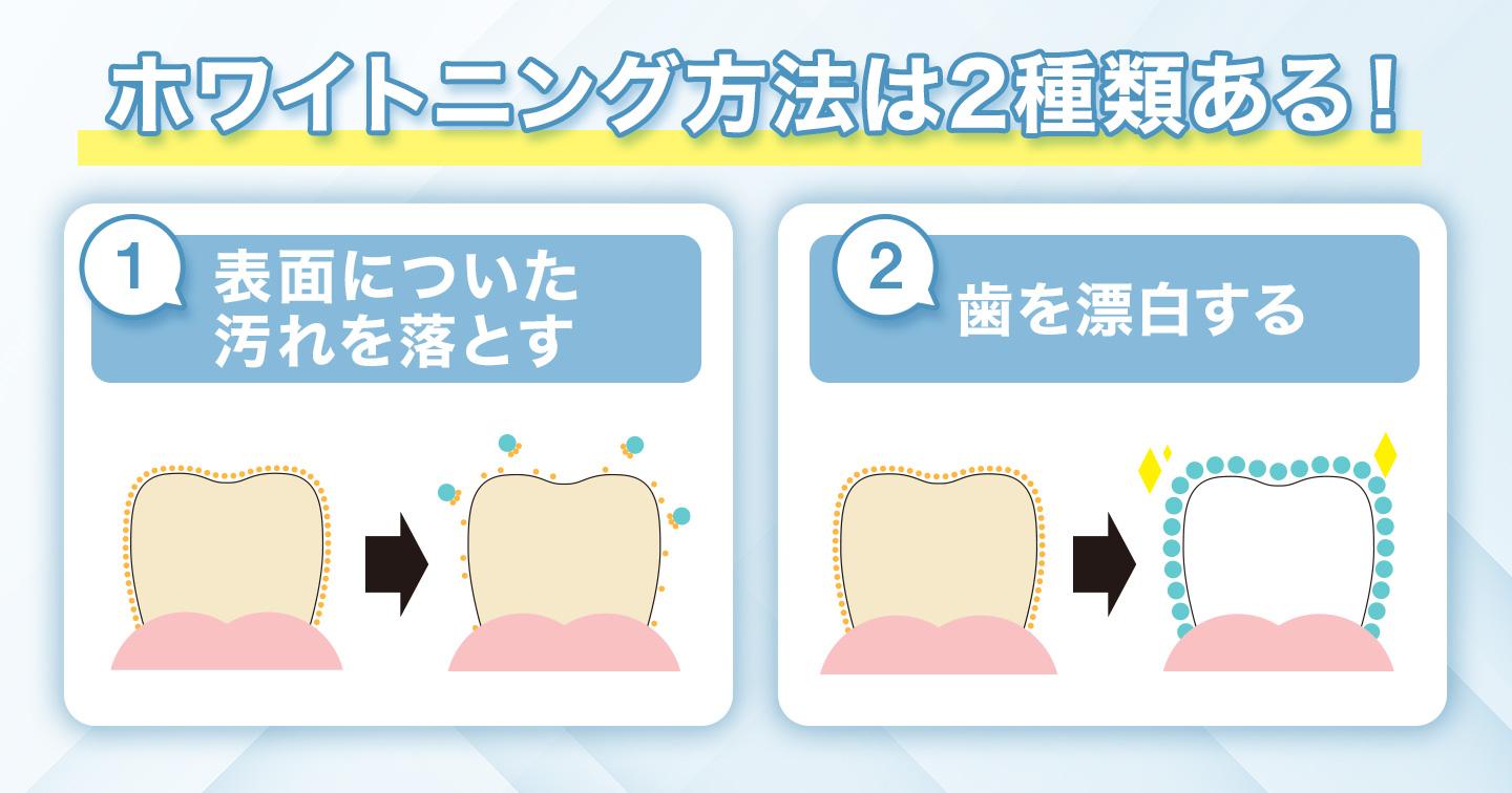 ホワイトニング方法は2種類ある!
