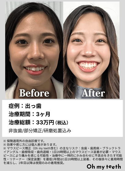 全顔BA・出っ歯