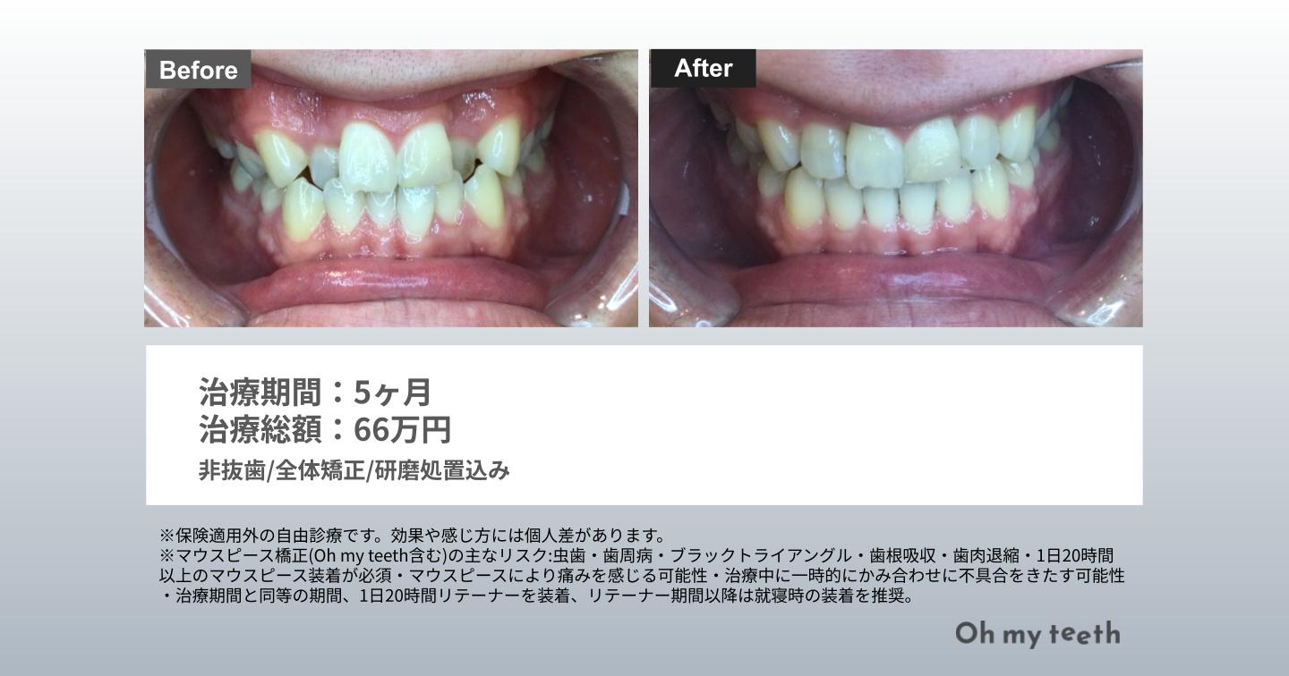 八重歯症例Pro