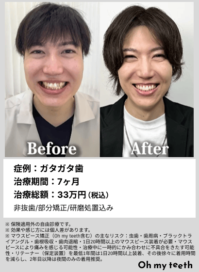 全顔BA・ガタガタ歯