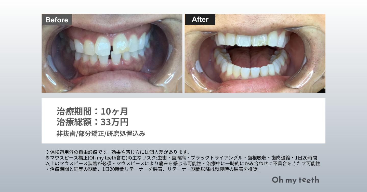 すきっ歯 矯正 前歯だけ 症例写真（すきっ歯10ヶ月）
