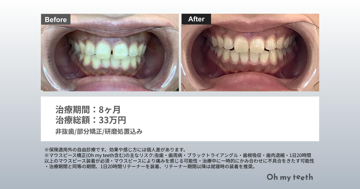 すきっ歯 矯正 前歯だけ 症例写真(すきっ歯8ヶ月）