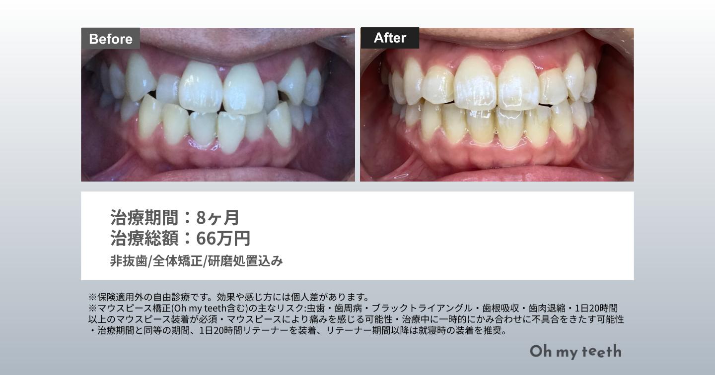 八重歯Pro