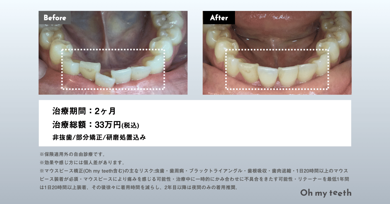マウスピース矯正 Oh my teethの症例(叢生)