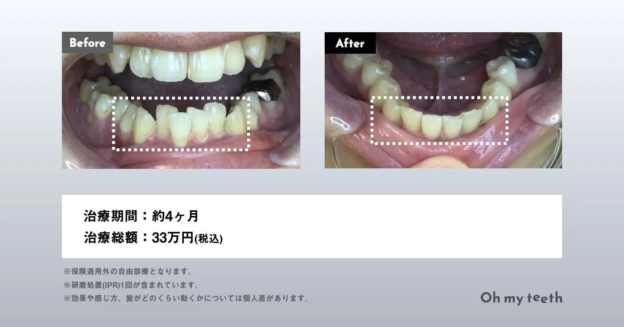 下の歯だけの矯正費用・種類・難しい症例を徹底解説!
