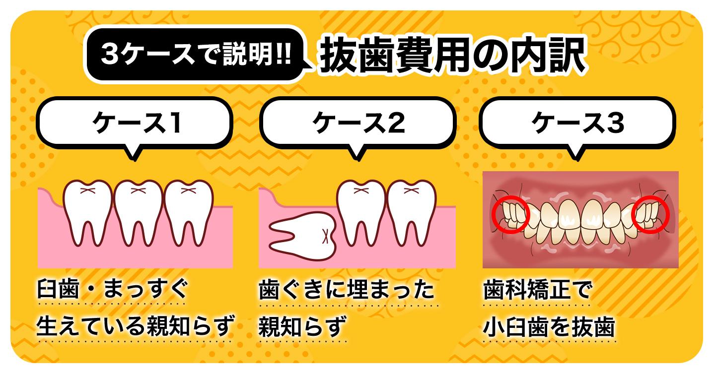 抜歯費用の内訳