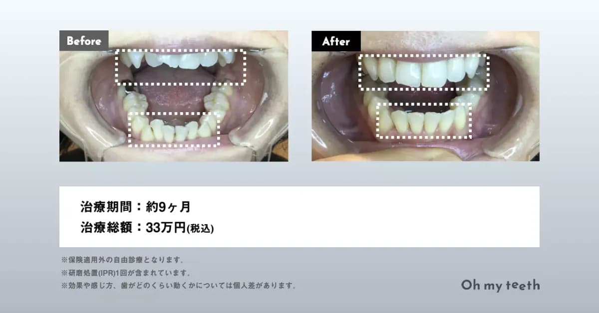 マウスピース矯正 Oh my teethの八重歯(叢生)の症例(部分矯正・非抜歯矯正)