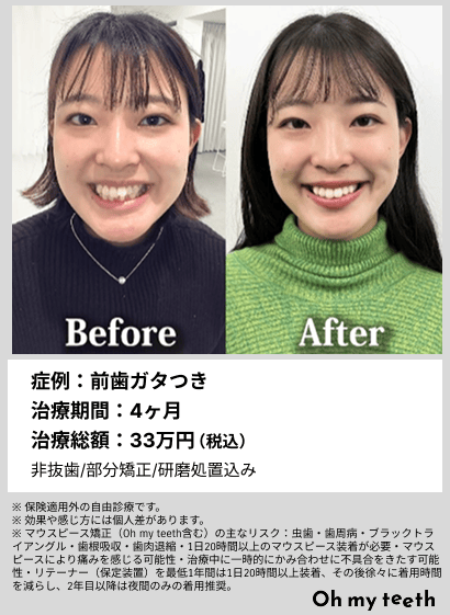 全顔BA・前歯ガタつき