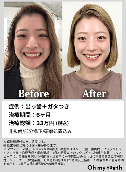 全顔BA・出っ歯+ガタつき