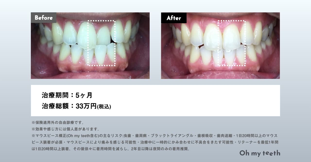 受け口(反対咬合)の症例