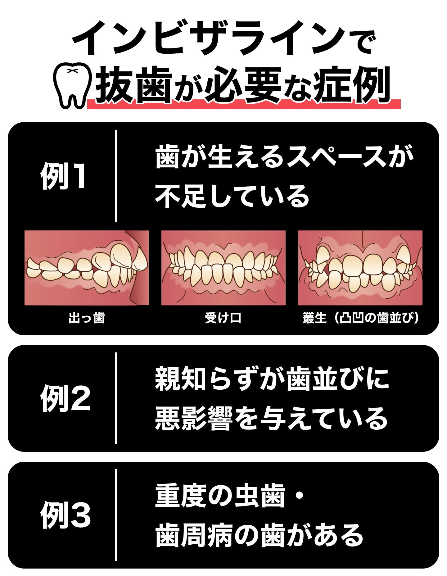 インビザラインで抜歯が必要な症例