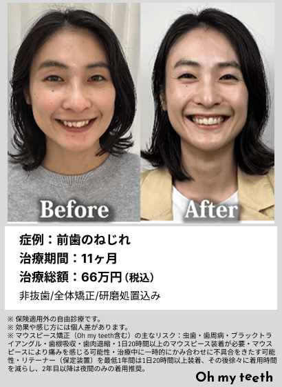 全顔BA・前歯のねじれ