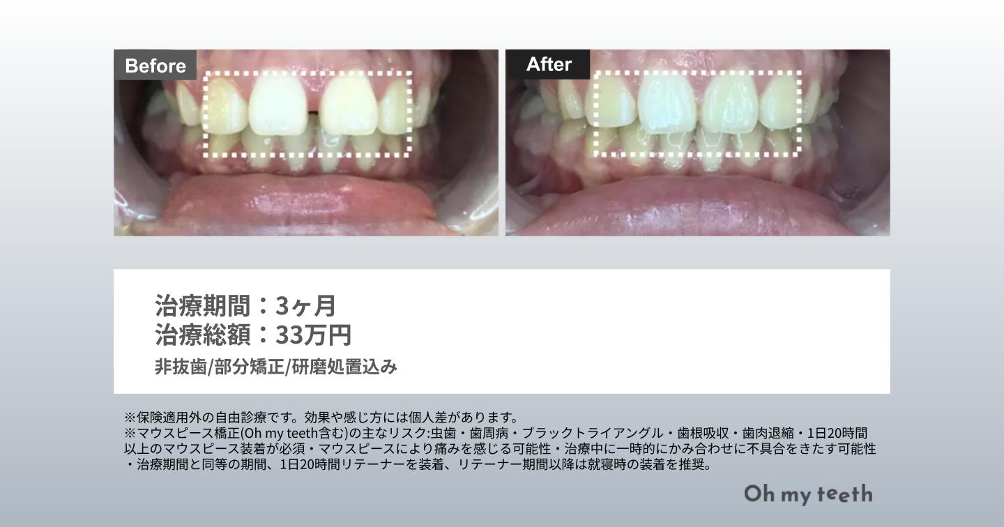 歯の隙間 埋める 症例写真（すきっぱ3ヶ月）