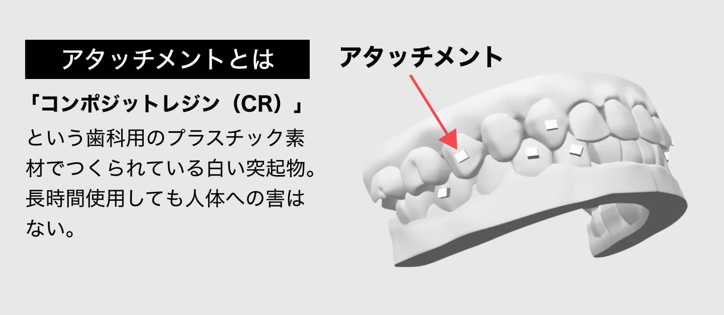 インビザラインのアタッチメントとは?絶対必要?気になる疑問を解説