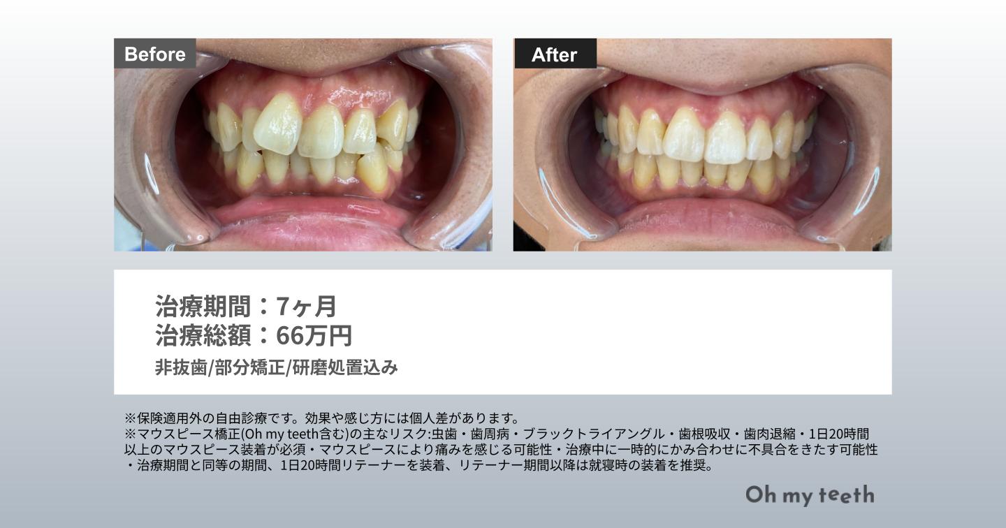 マウスピースとワイヤーどっちが安い症例 Pro