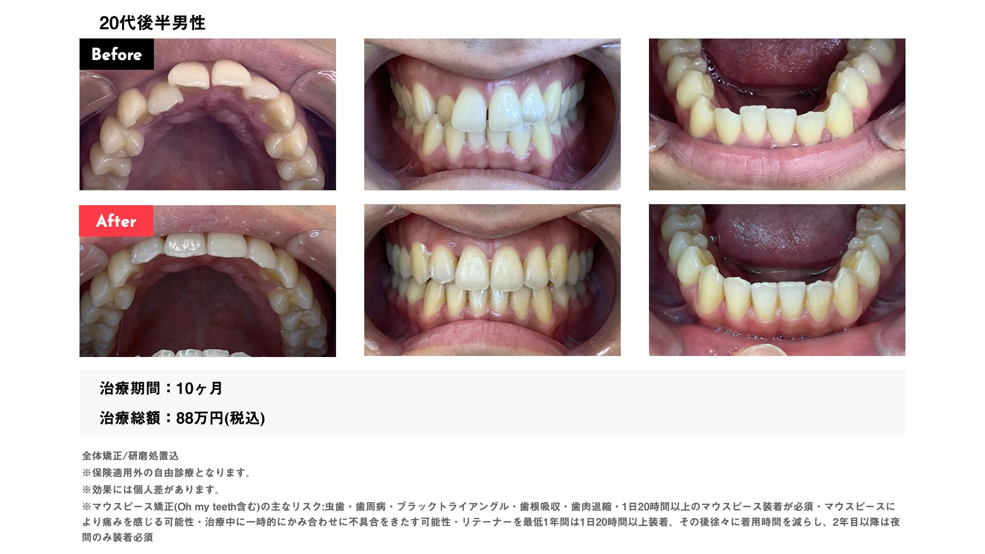 インビザライン10カ月・88万円・20代後半男性　八重歯・叢生