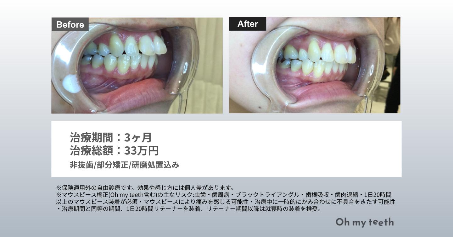 歯列矯正 やってよかった 症例写真データ(出っ歯3ヶ月）
