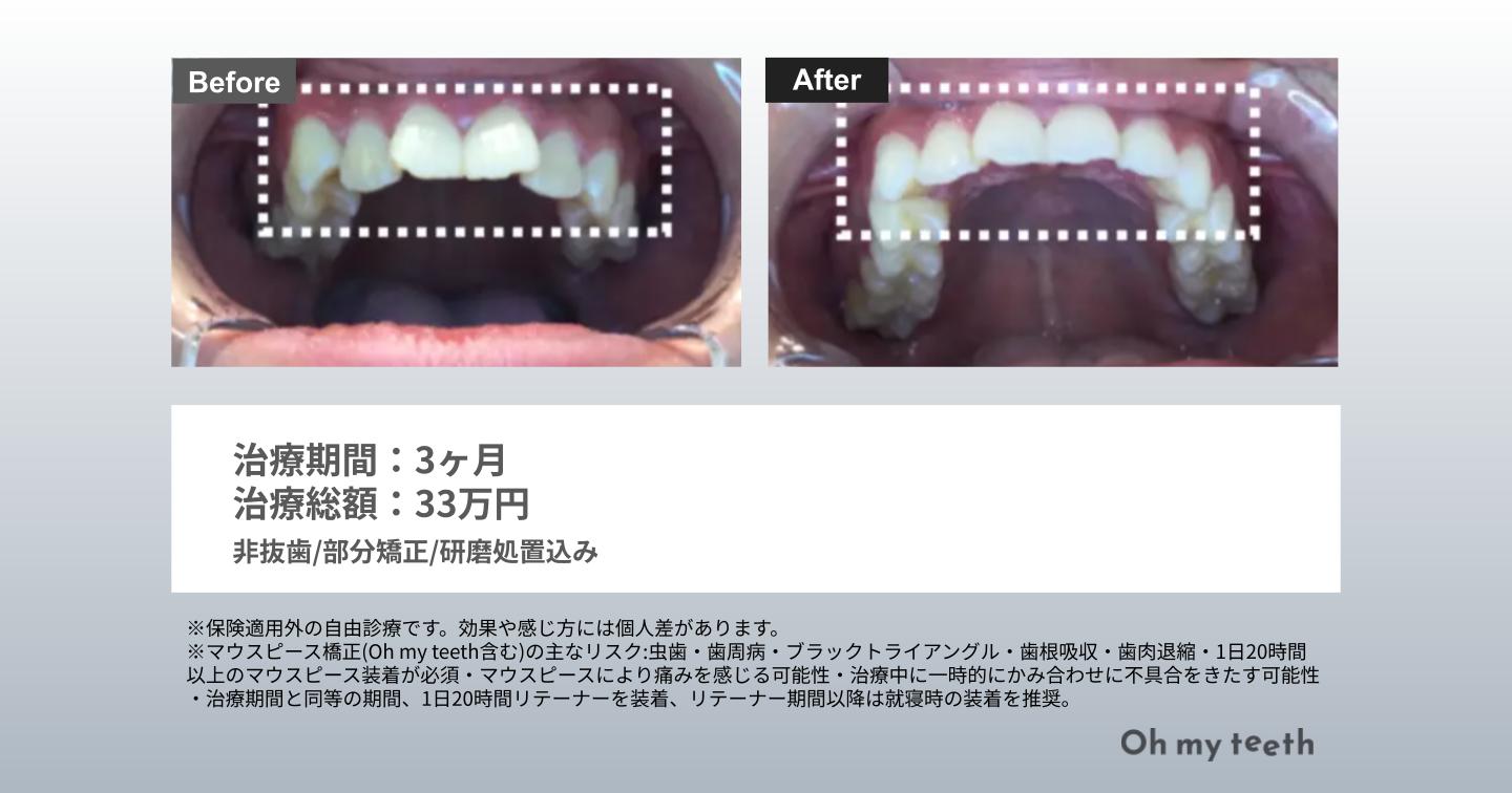 その他（ねじれた前歯）Basic