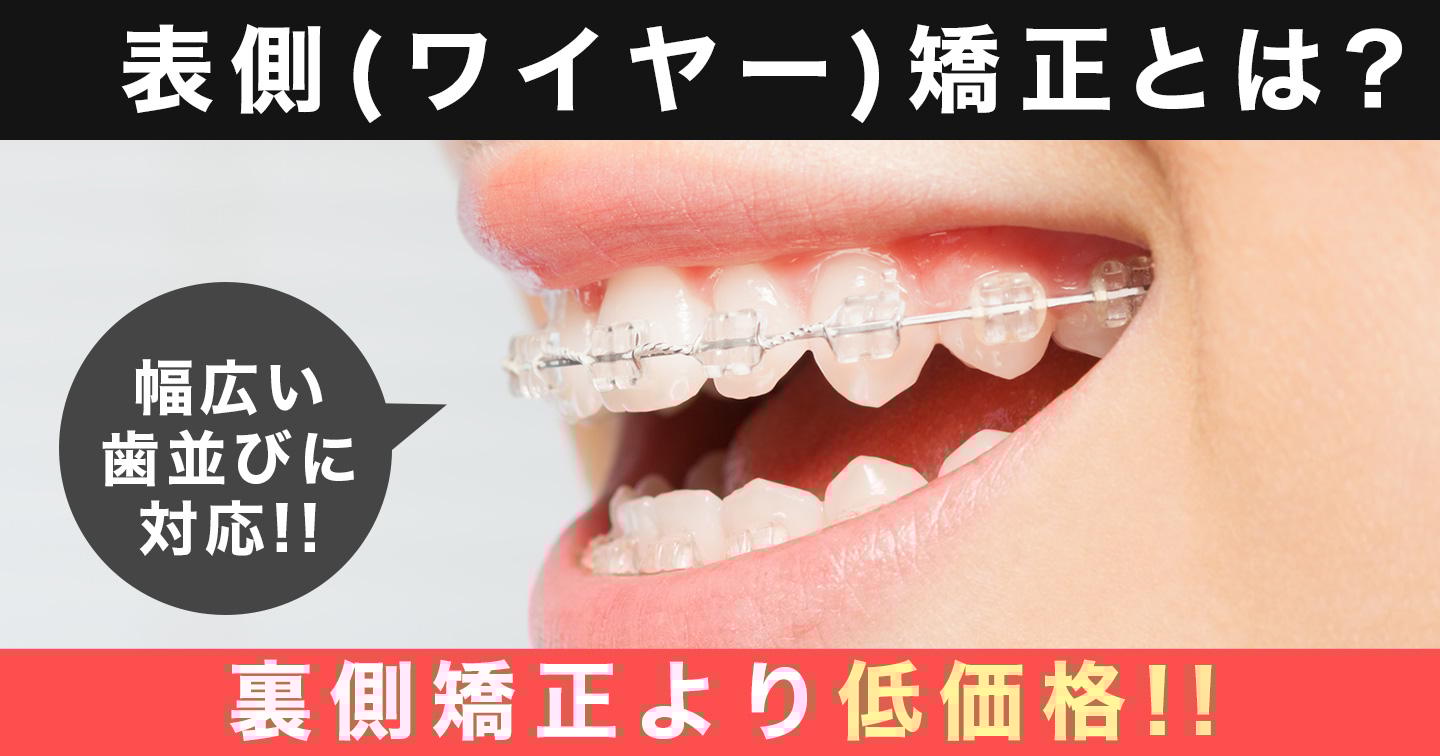 表側矯正とは
