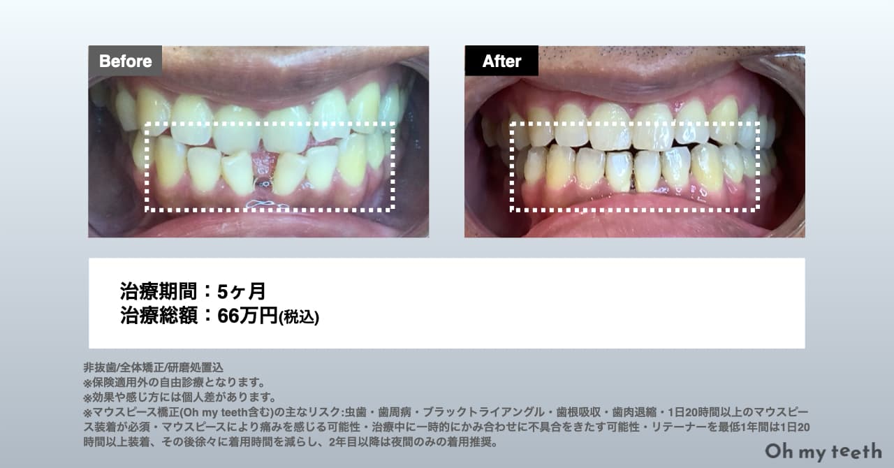 Oh my teethPro