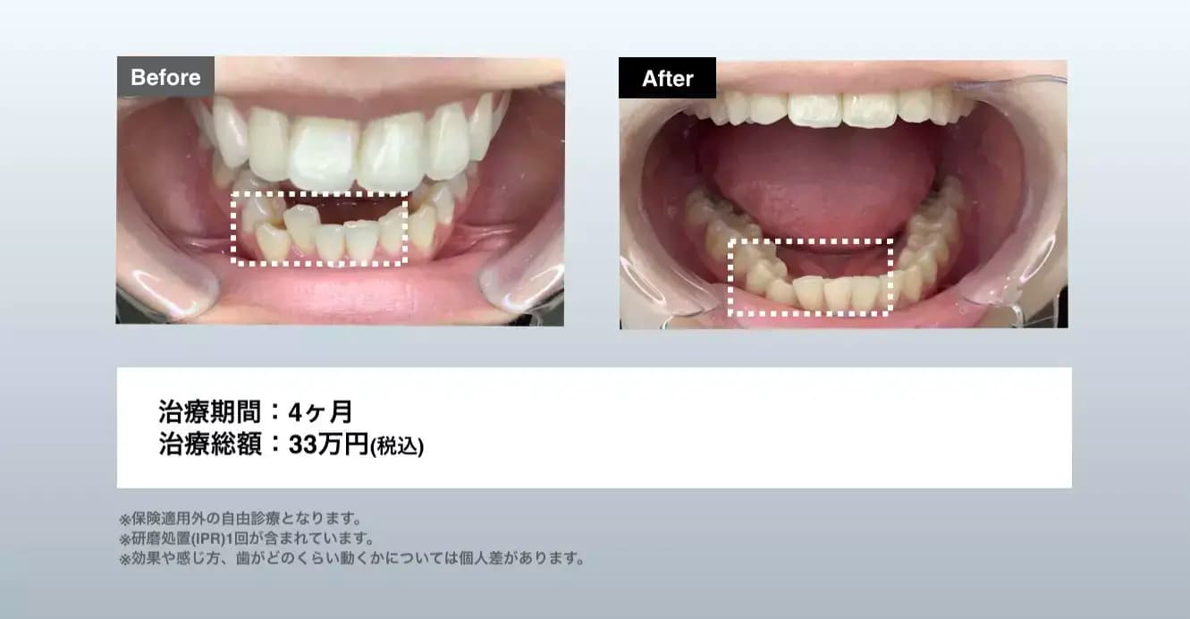 マウスピース矯正 Oh my teethのデコボコ