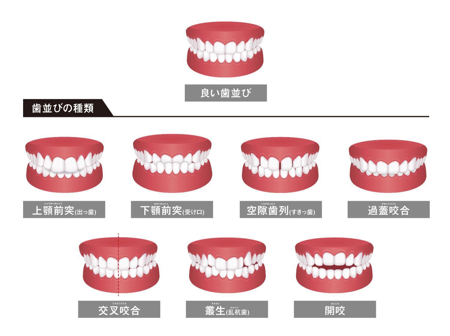 噛み合わせが悪いことで起こる8つの症状!原因や治し方も解説