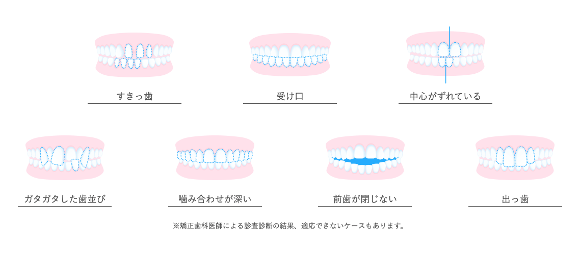 ウィスマイル矯正で対応できる歯並び一覧