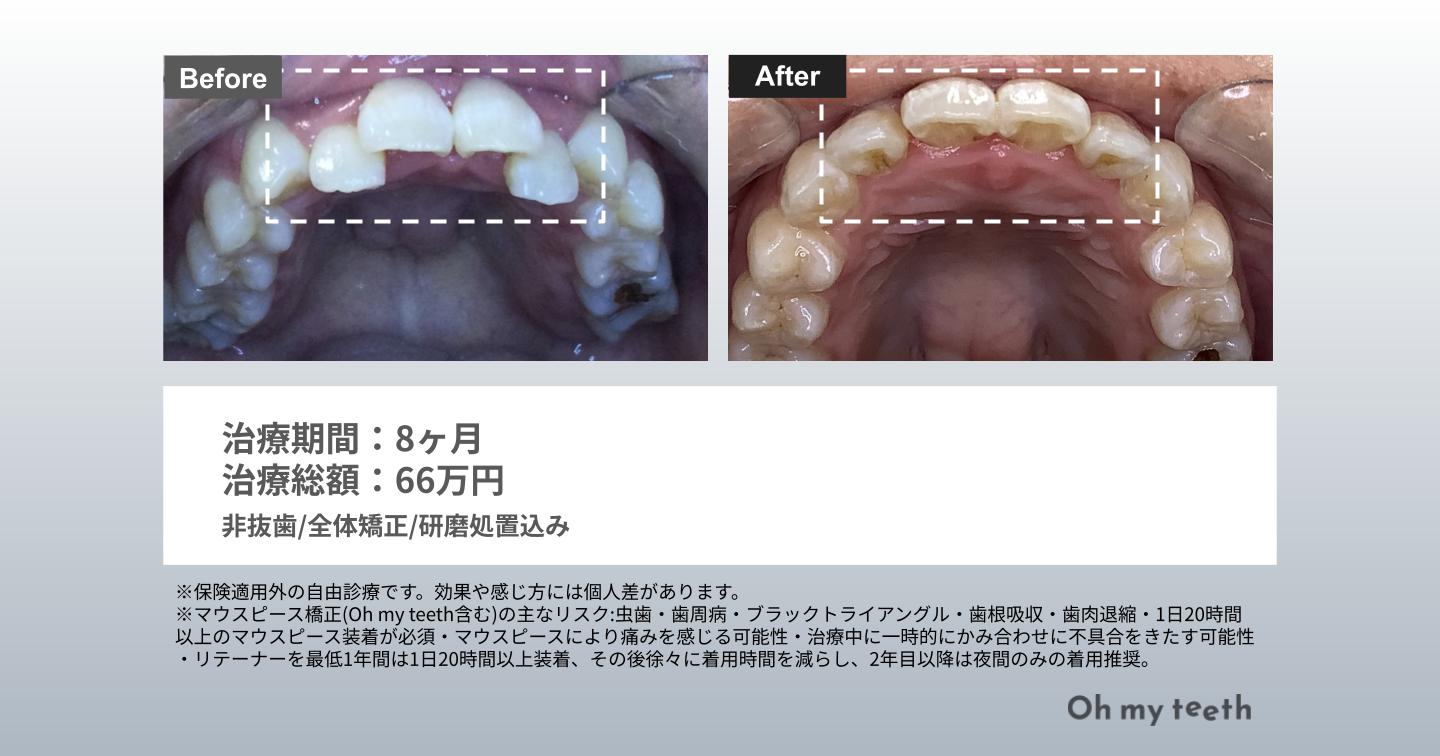 マウスピース矯正 Oh my teethの症例(全体矯正)