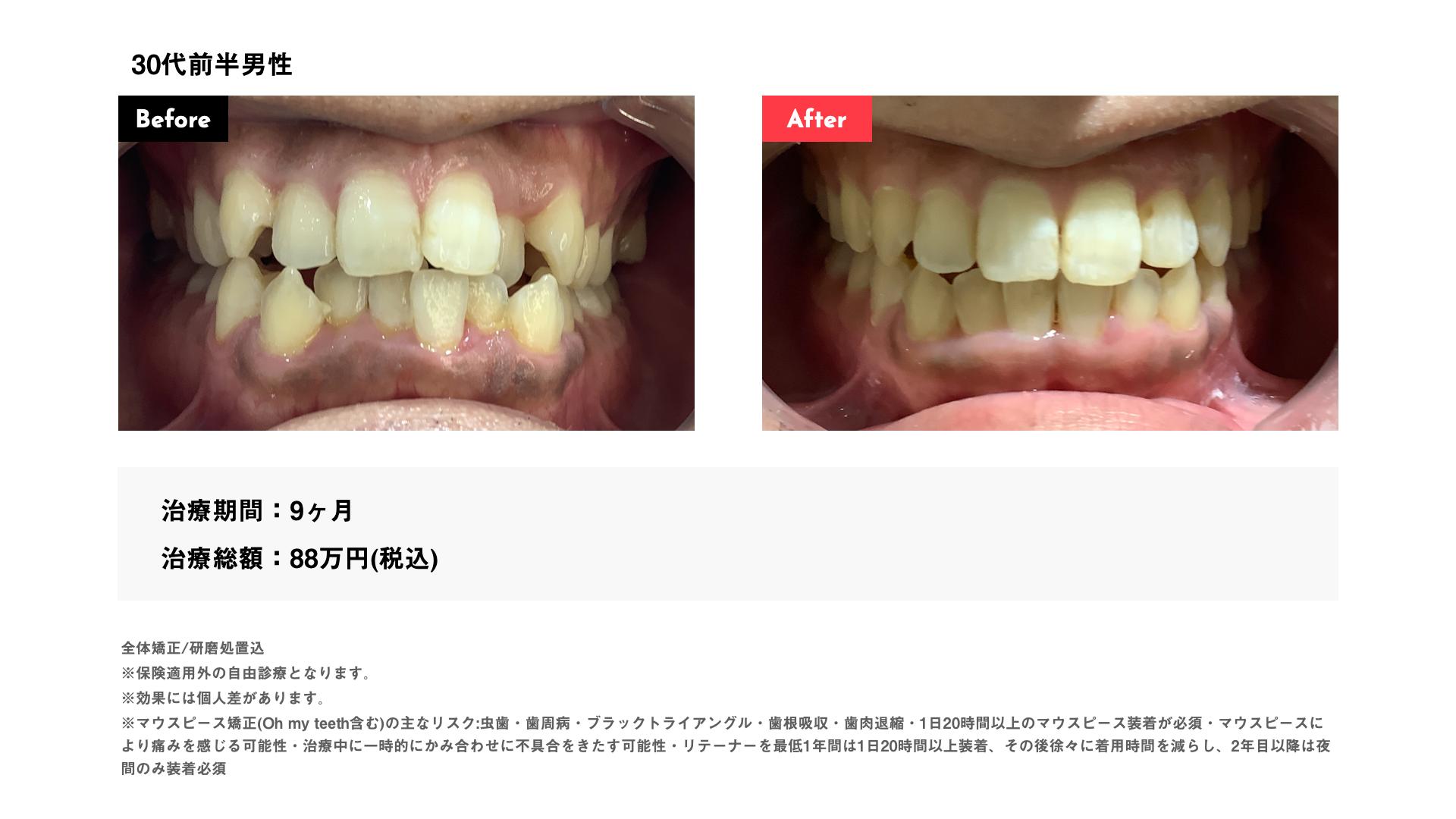 インビザライン9カ月・88万円・30代前半男性　八重歯・叢生