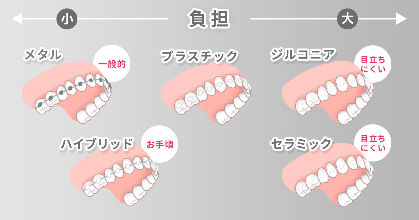 ワイヤー矯正装置の素�材別の相場